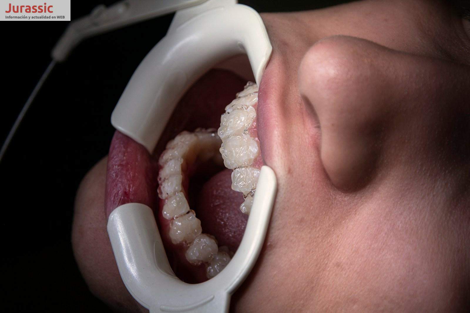 Precio de los implantes dentales