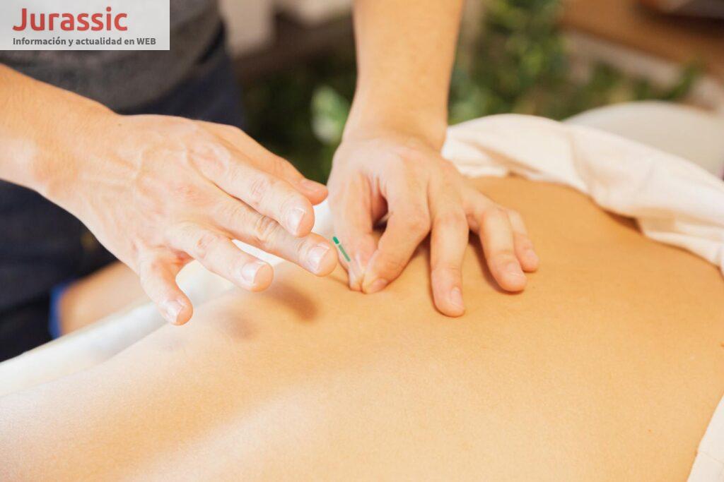 acupunctura