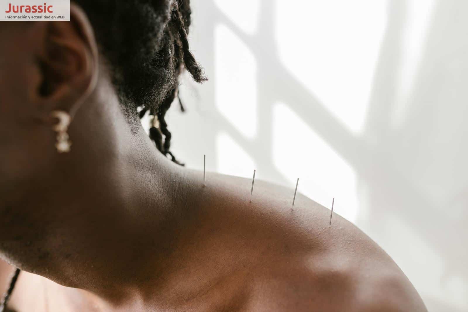 acupunctura